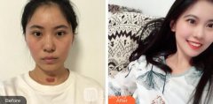南华大学附属第二医院美容科去疤痕案例