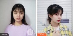 北大医院整形科隆鼻案例同步预览