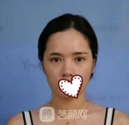 广州曙光整形美容医院隆鼻怎么样?案例分享