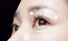 埋线法做双眼皮费用是多少？价格高吗？
