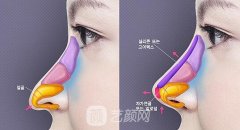 鹰钩鼻矫正大概需要多少钱？矫正图分享