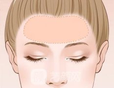 自体脂肪丰额头可以维持多久？脂肪的成活率高吗？