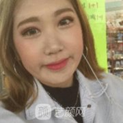 自体软骨隆鼻图一览，亲身经历自体软骨隆鼻恢复~