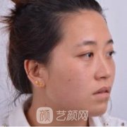 注射隆鼻图，短短一周恢复起来微创迹！