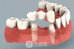 北京种植牙价格是怎么算的？口腔医院哪个较好？