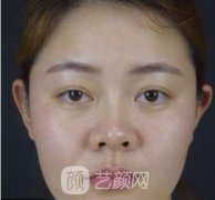 鼻孔缩小手术，前后改变真的令人惊讶！