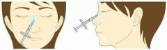 注射垫鼻梁果怎么样？费用是多少？