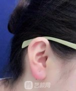 玻尿酸丰耳垂，真实恢复过程图一览！