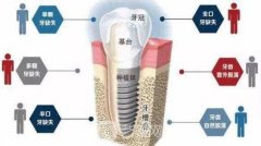 种植牙费用表多方面公布，多少钱一颗、利弊有哪些？多方位科普