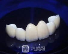 二氧化锆全瓷牙价格是多少？优势都表现在哪些方面？