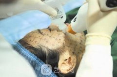 面部拉皮去皱整形有哪些方法？保持以及恢复的时间需要多久？
