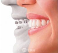 适美乐隐形正畸多少钱？适美乐和时代天使的区别是什么？