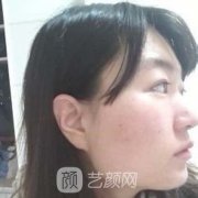 下颌角磨骨整形棒棒的，如今尖下巴的我特别美丽~
