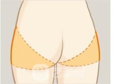 臀部吸脂手术大概需要多少钱？臀部吸脂手术有什么危害？