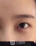开眼角图，开眼角恢复过程图一览！