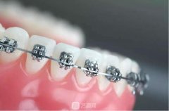 自锁牙套大概多少钱？和普通牙套的区别是什么？注意事项有哪些呢？
