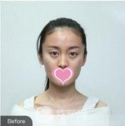 额头可以整形吗？自体脂肪丰额头前后果图~这就告诉你答案！