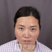 下颌角磨骨术恢复三个月，前后果片特明X，小V脸速成！