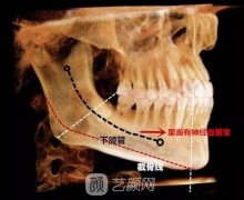 削腮骨手术后遗症有哪些？削腮骨手术费用是多少呢？有哪些优点？