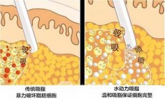 腰部吸脂手术费用多少？腰部吸脂多久可以恢复？有什么危害？