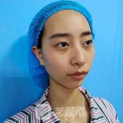 生物焊接双眼皮术前术后恢复过程图，果很棒，稳定不掉线！
