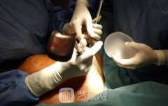 韩式假体隆胸痛吗？多少钱？果怎么样？