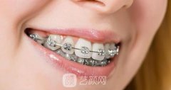 镍铬合金牙套对人体的危害是什么？多少钱一颗？价格明细表一览