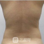 北京东方和谐王自谦吸脂案例恢复图上线!