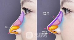 鹰钩鼻整形要多少钱？整形后自然吗？术后护理是怎样的呢？