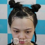 种头发果图片大全，发际线种植亲身经历分享~