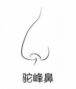 驼峰鼻矫正要多少钱？具体方法有哪些？注意事项是什么？