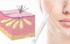 自体脂肪隆下巴疼吗？价格是多少？优势有哪些？