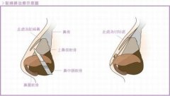 驼峰鼻矫正需要多少钱？果怎么样？术后会留疤吗？