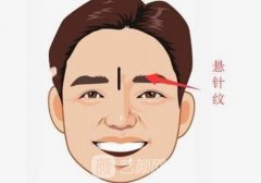 怎样去除悬针纹？悬针纹是什么意思？如何预防？