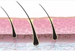 植发为什么这么贵？植发果好吗？植发疼吗？