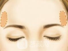 自体脂肪填充太阳穴凹陷多少钱？填充的危害是什么？