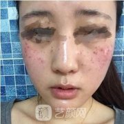 宁波二院整形科祛斑果多图浏览，整形果怎么样？