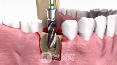 种植牙的使用寿命有多久？种植牙的好处有哪些？