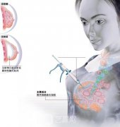自体脂肪隆胸可以保持多少年？价格大约是多少？
