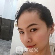 移植毛发果图，案例图+恢复全过程~