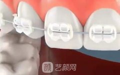 自锁托槽价格是多少？自锁托槽和普通的区别是什么？