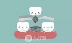 复合树脂补牙多少钱？能用多少年？多久可以吃东西