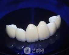 种植满口牙需要多少钱？大概需要多少天？果好吗？