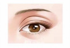 埋线法割双眼皮价格是多少？埋线法割双眼皮恢复过程图