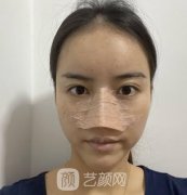 重庆鹏爱医疗美容医院隆鼻案例果如何？