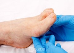 大脚骨手术费用是多少钱？多久恢复正常？有后遗症吗？