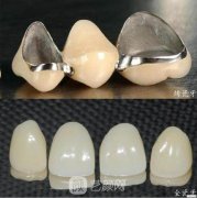 镍铬合金烤瓷牙优缺点是什么？可以做核磁共振吗？