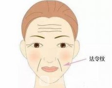 法令纹是哪个部位？法令纹去除的方式有哪些？