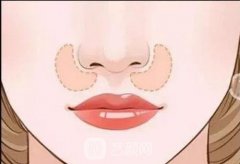 怎么让鼻翼缩小？鼻翼缩小的优点是什么？