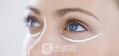 北京祛眼袋多少钱？北京祛眼袋较好的医生是哪位？